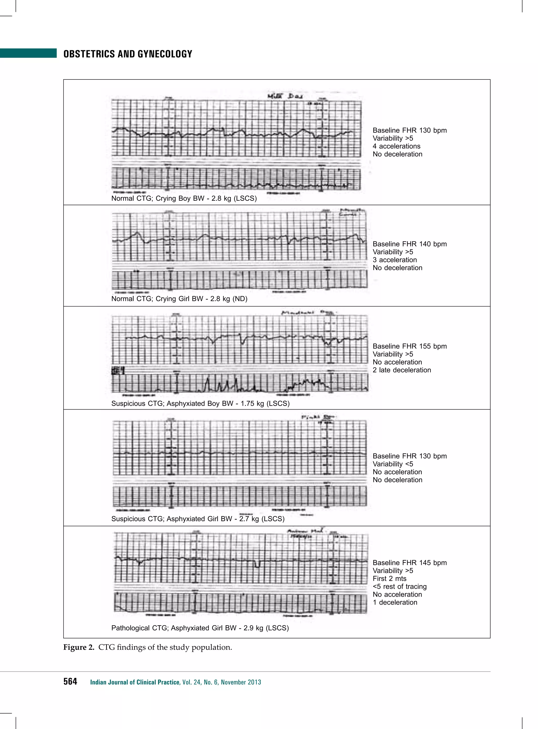 Obstetrics and Gynecology

Baseline FHR 130 bpm
Variability >5
4 accelerations
No deceleration

Normal CTG; Crying Boy BW - 2.8 kg (LSCS)

Baseline FHR 140 bpm
Variability >5
3 acceleration
No deceleration

Normal CTG; Crying Girl BW - 2.8 kg (ND)

Baseline FHR 155 bpm
Variability >5
No acceleration
2 late deceleration

Suspicious CTG; Asphyxiated Boy BW - 1.75 kg (LSCS)

Baseline FHR 130 bpm
Variability <5
No acceleration
No deceleration

Suspicious CTG; Asphyxiated Girl BW - 2.7 kg (LSCS)

Baseline FHR 145 bpm
Variability >5
First 2 mts
<5 rest of tracing
No acceleration
1 deceleration
Pathological CTG; Asphyxiated Girl BW - 2.9 kg (LSCS)

Figure 2. CTG findings of the study population.

564

Indian Journal of Clinical Practice, Vol. 24, No. 6, November 2013

 