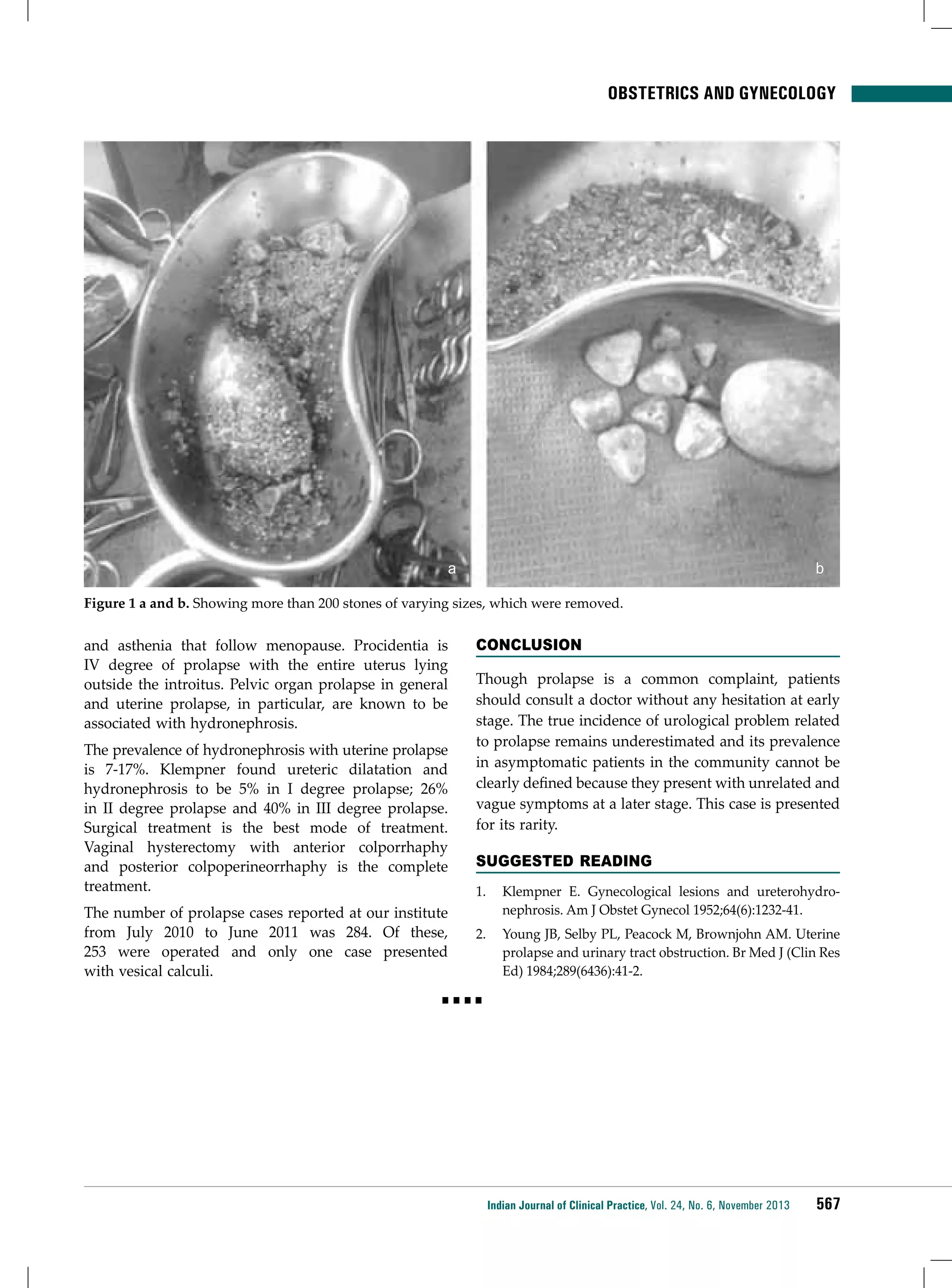 Obstetrics and Gynecology

a

b

Figure 1 a and b. Showing more than 200 stones of varying sizes, which were removed.

and asthenia that follow menopause. Procidentia is
IV degree of prolapse with the entire uterus lying
outside the introitus. Pelvic organ prolapse in general
and uterine prolapse, in particular, are known to be
associated with hydronephrosis.
The prevalence of hydronephrosis with uterine prolapse
is 7-17%. Klempner found ureteric dilatation and
hydronephrosis to be 5% in I degree prolapse; 26%
in II degree prolapse and 40% in III degree prolapse.
Surgical treatment is the best mode of treatment.
Vaginal hysterectomy with anterior colporrhaphy
and posterior colpoperineorrhaphy is the complete
treatment.
The number of prolapse cases reported at our institute
from July 2010 to June 2011 was 284. Of these,
253 were operated and only one case presented
with vesical calculi.

Conclusion
Though prolapse is a common complaint, patients
should consult a doctor without any hesitation at early
stage. The true incidence of urological problem related
to prolapse remains underestimated and its prevalence
in asymptomatic patients in the community cannot be
clearly defined because they present with unrelated and
vague symptoms at a later stage. This case is presented
for its rarity.
Suggested Reading
1.	 Klempner E. Gynecological lesions and ureterohydronephrosis. Am J Obstet Gynecol 1952;64(6):1232-41.
2.	 Young JB, Selby PL, Peacock M, Brownjohn AM. Uterine
prolapse and urinary tract obstruction. Br Med J (Clin Res
Ed) 1984;289(6436):41-2.

■■■■

Indian Journal of Clinical Practice, Vol. 24, No. 6, November 2013

567

 