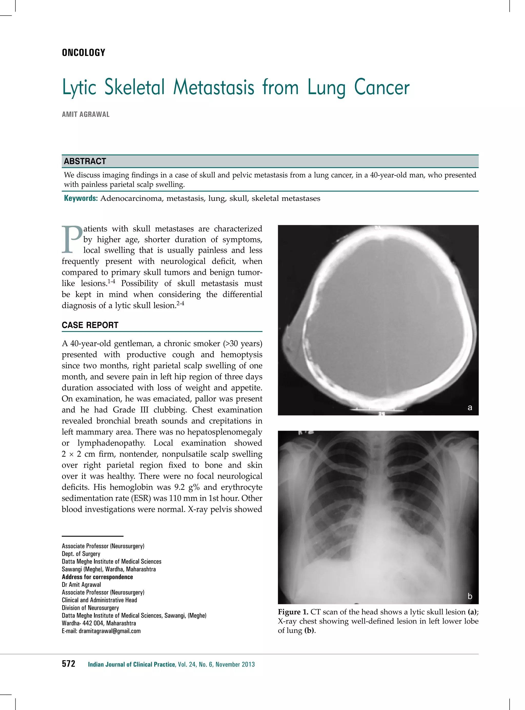 ONCOLOGY

Lytic Skeletal Metastasis from Lung Cancer
Amit Agrawal

Abstract
We discuss imaging findings in a case of skull and pelvic metastasis from a lung cancer, in a 40-year-old man, who presented
with painless parietal scalp swelling.

Keywords: Adenocarcinoma, metastasis, lung, skull, skeletal metastases

P

atients with skull metastases are characterized
by higher age, shorter duration of symptoms,
local swelling that is usually painless and less
frequently present with neurological deficit, when
compared to primary skull tumors and benign tumorlike lesions.1-4 Possibility of skull metastasis must
be kept in mind when considering the differential
diagnosis of a lytic skull lesion.2-4
Case report
A 40-year-old gentleman, a chronic smoker (>30 years)
presented with productive cough and hemoptysis
since two months, right parietal scalp swelling of one
month, and severe pain in left hip region of three days
duration associated with loss of weight and appetite.
On examination, he was emaciated, pallor was present
and he had Grade III clubbing. Chest examination
revealed bronchial breath sounds and crepitations in
left mammary area. There was no hepatosplenomegaly
or lymphadenopathy. Local examination showed
2 × 2 cm firm, nontender, nonpulsatile scalp swelling
over right parietal region fixed to bone and skin
over it was healthy. There were no focal neurological
deficits. His hemoglobin was 9.2 g% and erythrocyte
sedimentation rate (ESR) was 110 mm in 1st hour. Other
blood investigations were normal. X-ray pelvis showed

Associate Professor (Neurosurgery)
Dept. of Surgery
Datta Meghe Institute of Medical Sciences
Sawangi (Meghe), Wardha, Maharashtra
Address for correspondence
Dr Amit Agrawal
Associate Professor (Neurosurgery)
Clinical and Administrative Head
Division of Neurosurgery
Datta Meghe Institute of Medical Sciences, Sawangi, (Meghe)
Wardha- 442 004, Maharashtra
E-mail: dramitagrawal@gmail.com

572

Indian Journal of Clinical Practice, Vol. 24, No. 6, November 2013

a

b
Figure 1. CT scan of the head shows a lytic skull lesion (a);
X-ray chest showing well-defined lesion in left lower lobe
of lung (b).

 