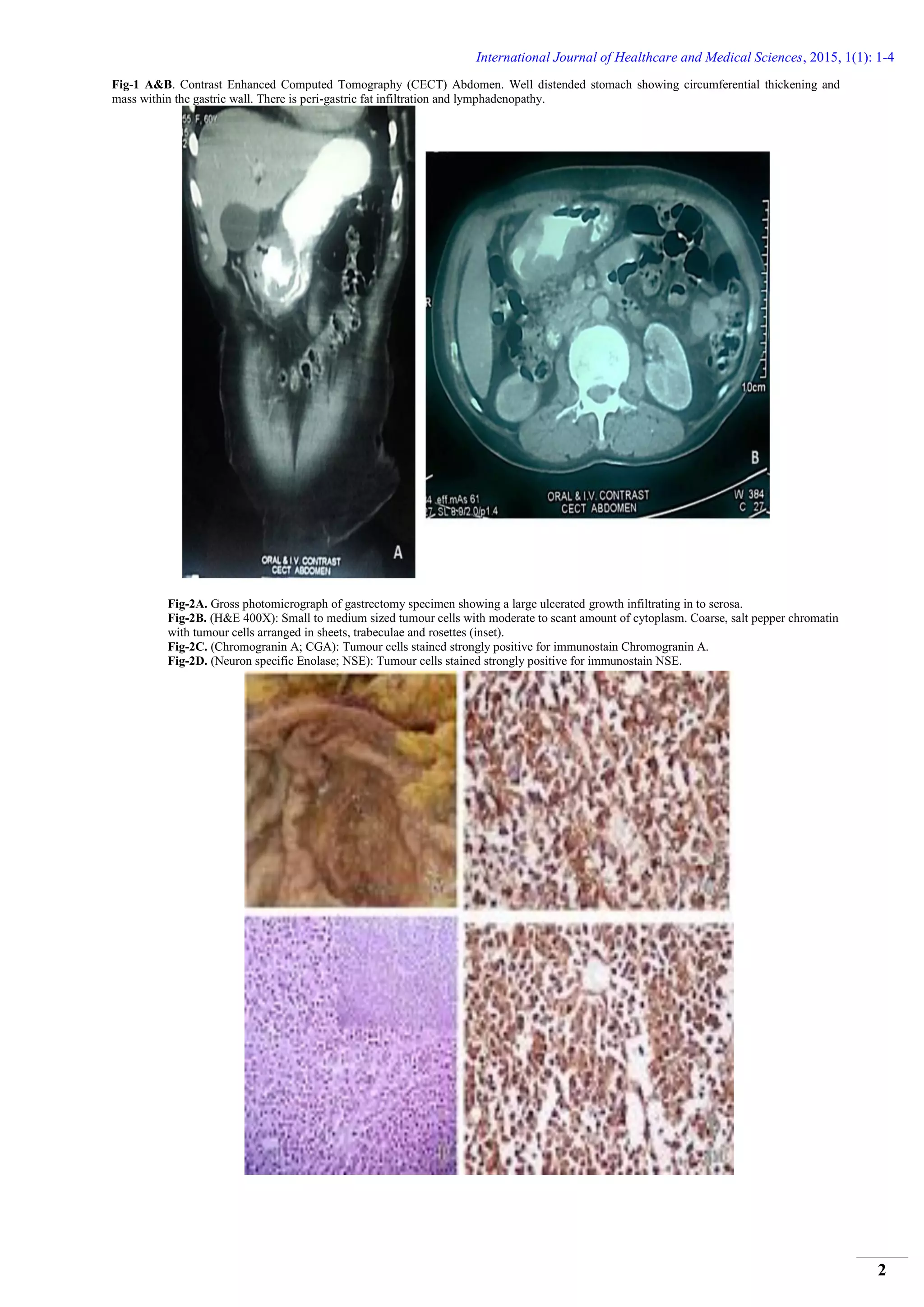 Neuroendocrine Carcinoma of the Stomach: A Case Report | PDF