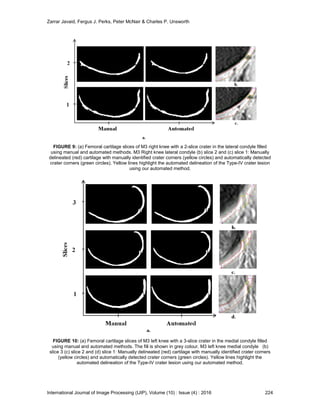 A Geometrical Heuristic Image Processing Approach For The Automatic Detection & Quantification of Type-IV Crater Lesion Pathology In The Femoral Cartilage of The Human Knee