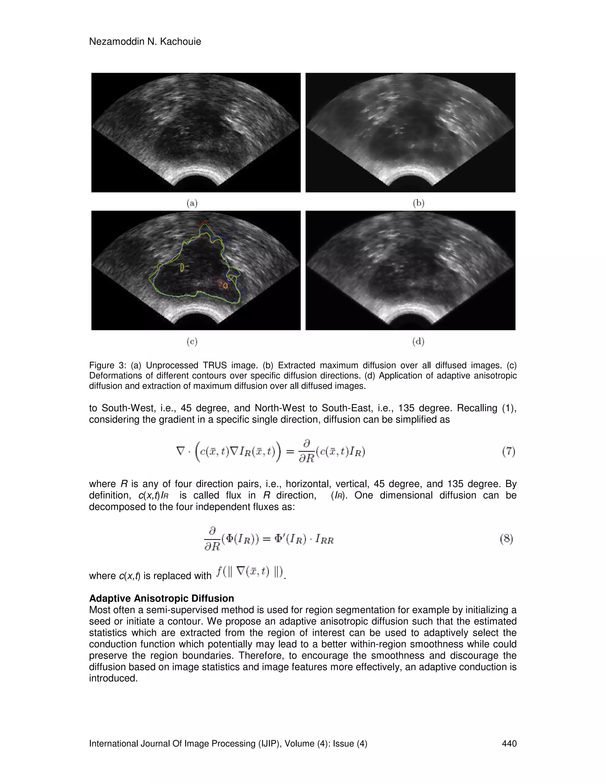 Nezamoddin N. Kachouie
International Journal Of Image Processing (IJIP), Volume (4): Issue (4) 440
Figure 3: (a) Unprocessed TRUS image. (b) Extracted maximum diffusion over all diffused images. (c)
Deformations of different contours over specific diffusion directions. (d) Application of adaptive anisotropic
diffusion and extraction of maximum diffusion over all diffused images.
to South-West, i.e., 45 degree, and North-West to South-East, i.e., 135 degree. Recalling (1),
considering the gradient in a specific single direction, diffusion can be simplified as
where R is any of four direction pairs, i.e., horizontal, vertical, 45 degree, and 135 degree. By
definition, c(x,t)IR is called flux in R direction, (IR). One dimensional diffusion can be
decomposed to the four independent fluxes as:
where c(x,t) is replaced with .
Adaptive Anisotropic Diffusion
Most often a semi-supervised method is used for region segmentation for example by initializing a
seed or initiate a contour. We propose an adaptive anisotropic diffusion such that the estimated
statistics which are extracted from the region of interest can be used to adaptively select the
conduction function which potentially may lead to a better within-region smoothness while could
preserve the region boundaries. Therefore, to encourage the smoothness and discourage the
diffusion based on image statistics and image features more effectively, an adaptive conduction is
introduced.
 