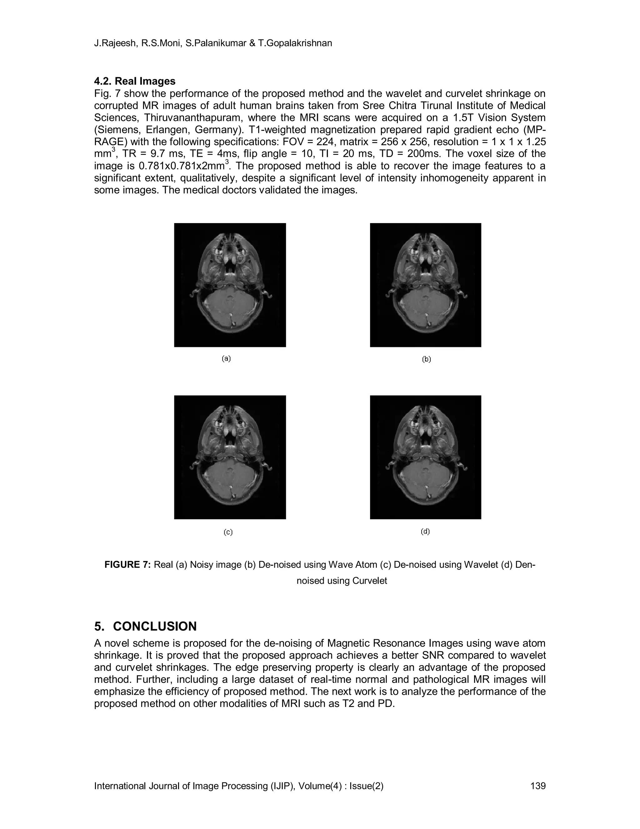 J.Rajeesh, R.S.Moni, S.Palanikumar & T.Gopalakrishnan
International Journal of Image Processing (IJIP), Volume(4) : Issue(2) 139
4.2. Real Images
Fig. 7 show the performance of the proposed method and the wavelet and curvelet shrinkage on
corrupted MR images of adult human brains taken from Sree Chitra Tirunal Institute of Medical
Sciences, Thiruvananthapuram, where the MRI scans were acquired on a 1.5T Vision System
(Siemens, Erlangen, Germany). T1-weighted magnetization prepared rapid gradient echo (MP-
RAGE) with the following specifications: FOV = 224, matrix = 256 x 256, resolution = 1 x 1 x 1.25
mm3
, TR = 9.7 ms, TE = 4ms, flip angle = 10, TI = 20 ms, TD = 200ms. The voxel size of the
image is 0.781x0.781x2mm
3
. The proposed method is able to recover the image features to a
significant extent, qualitatively, despite a significant level of intensity inhomogeneity apparent in
some images. The medical doctors validated the images.
FIGURE 7: Real (a) Noisy image (b) De-noised using Wave Atom (c) De-noised using Wavelet (d) Den-
noised using Curvelet
5. CONCLUSION
A novel scheme is proposed for the de-noising of Magnetic Resonance Images using wave atom
shrinkage. It is proved that the proposed approach achieves a better SNR compared to wavelet
and curvelet shrinkages. The edge preserving property is clearly an advantage of the proposed
method. Further, including a large dataset of real-time normal and pathological MR images will
emphasize the efficiency of proposed method. The next work is to analyze the performance of the
proposed method on other modalities of MRI such as T2 and PD.
 