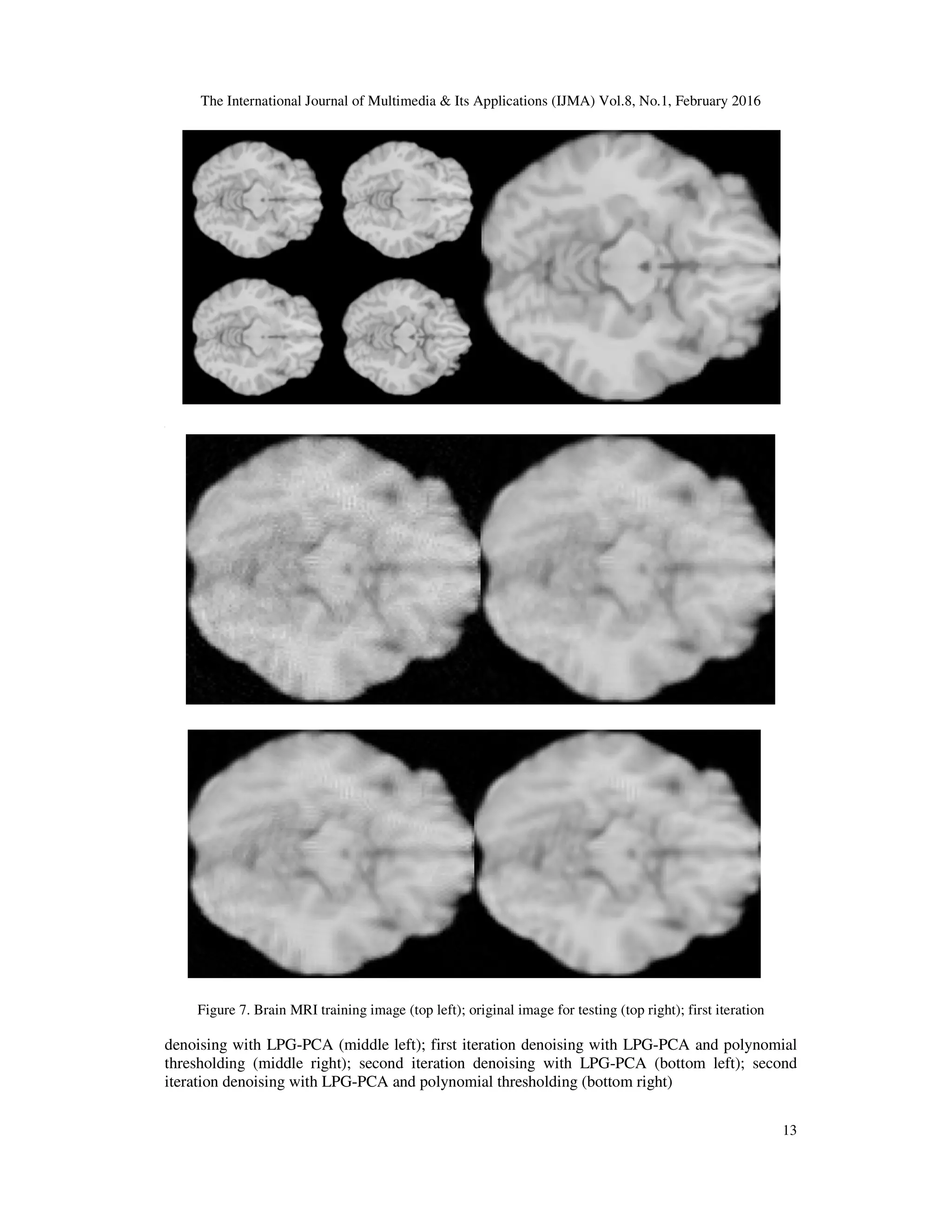 The International Journal of Multimedia & Its Applications (IJMA) Vol.8, No.1, February 2016 13 [ Figure 7. Brain MRI training image (top left); original image for testing (top right); first iteration denoising with LPG-PCA (middle left); first iteration denoising with LPG-PCA and polynomial thresholding (middle right); second iteration denoising with LPG-PCA (bottom left); second iteration denoising with LPG-PCA and polynomial thresholding (bottom right) 