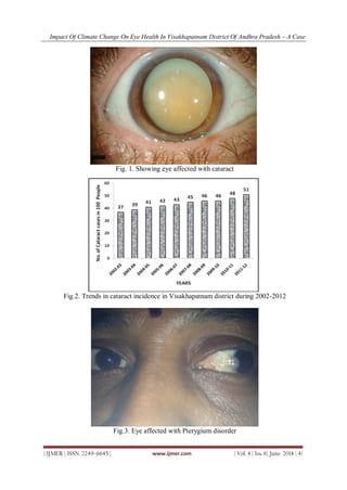 Impact Of Climate Change On Eye Health In Visakhapatnam District Of Andhra Pradesh – A Case
| IJMER | ISSN: 2249–6645 | www.ijmer.com | Vol. 4 | Iss. 6| June. 2014 | 4|
Fig. 1. Showing eye affected with cataract
Fig.2. Trends in cataract incidence in Visakhapatnam district during 2002-2012
Fig.3. Eye affected with Pterygium disorder
 