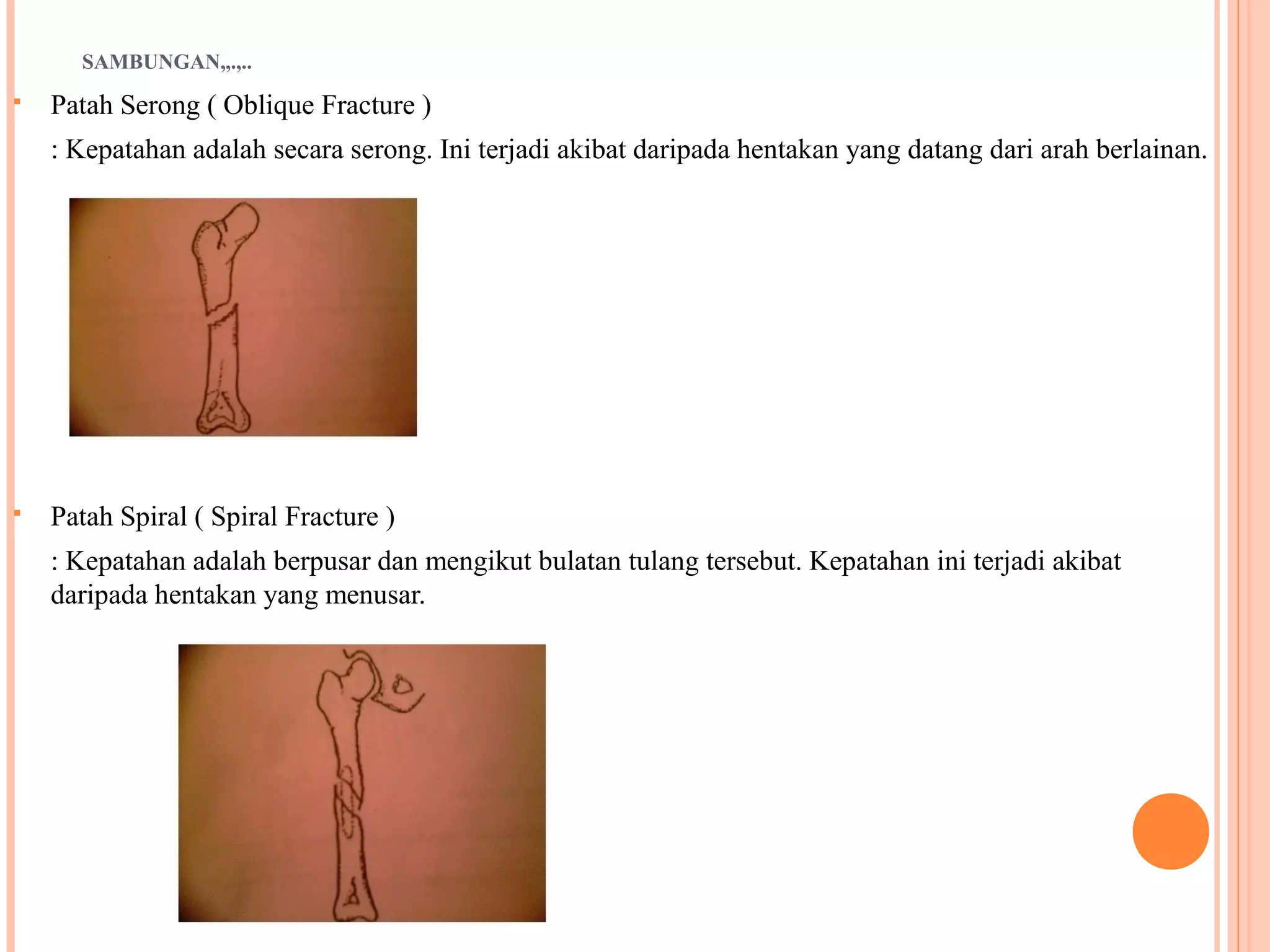 SAMBUNGAN,,.,..
 Patah Serong ( Oblique Fracture )
: Kepatahan adalah secara serong. Ini terjadi akibat daripada hentakan yang datang dari arah berlainan.
 Patah Spiral ( Spiral Fracture )
: Kepatahan adalah berpusar dan mengikut bulatan tulang tersebut. Kepatahan ini terjadi akibat
daripada hentakan yang menusar.
 