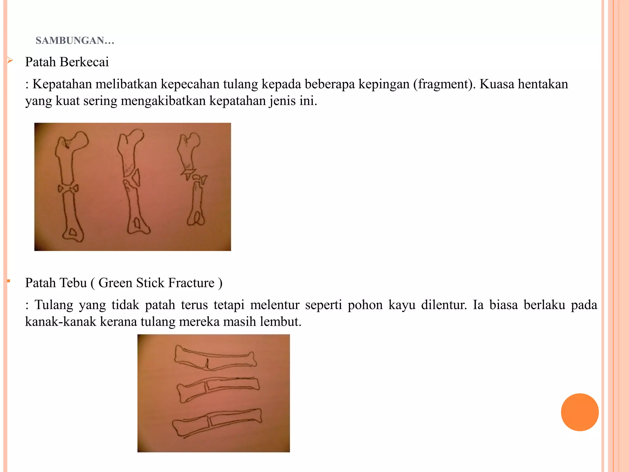 SAMBUNGAN…
 Patah Berkecai
: Kepatahan melibatkan kepecahan tulang kepada beberapa kepingan (fragment). Kuasa hentakan
yang kuat sering mengakibatkan kepatahan jenis ini.
 Patah Tebu ( Green Stick Fracture )
: Tulang yang tidak patah terus tetapi melentur seperti pohon kayu dilentur. Ia biasa berlaku pada
kanak-kanak kerana tulang mereka masih lembut.
 