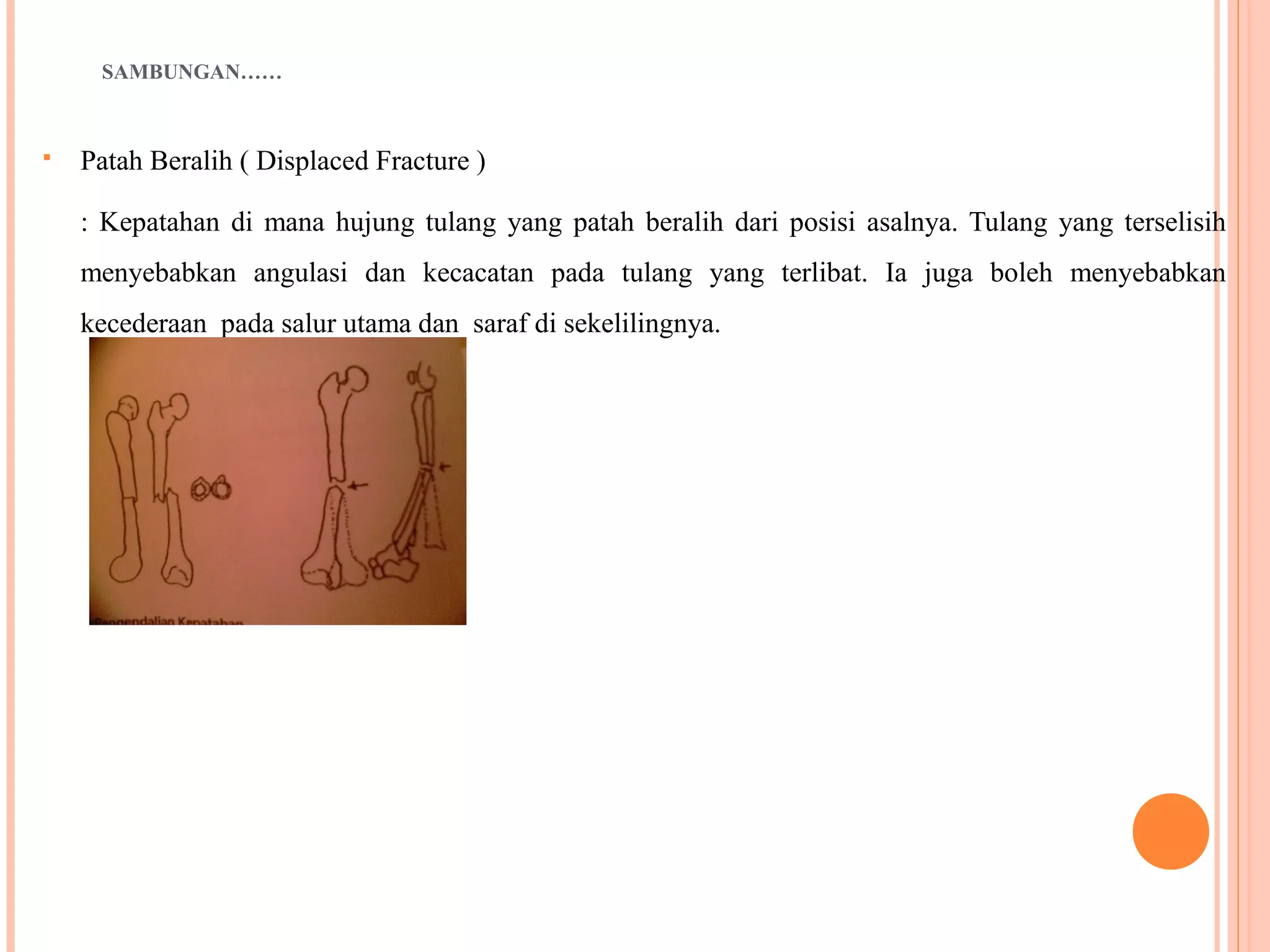 SAMBUNGAN……
 Patah Beralih ( Displaced Fracture )
: Kepatahan di mana hujung tulang yang patah beralih dari posisi asalnya. Tulang yang terselisih
menyebabkan angulasi dan kecacatan pada tulang yang terlibat. Ia juga boleh menyebabkan
kecederaan pada salur utama dan saraf di sekelilingnya.
 