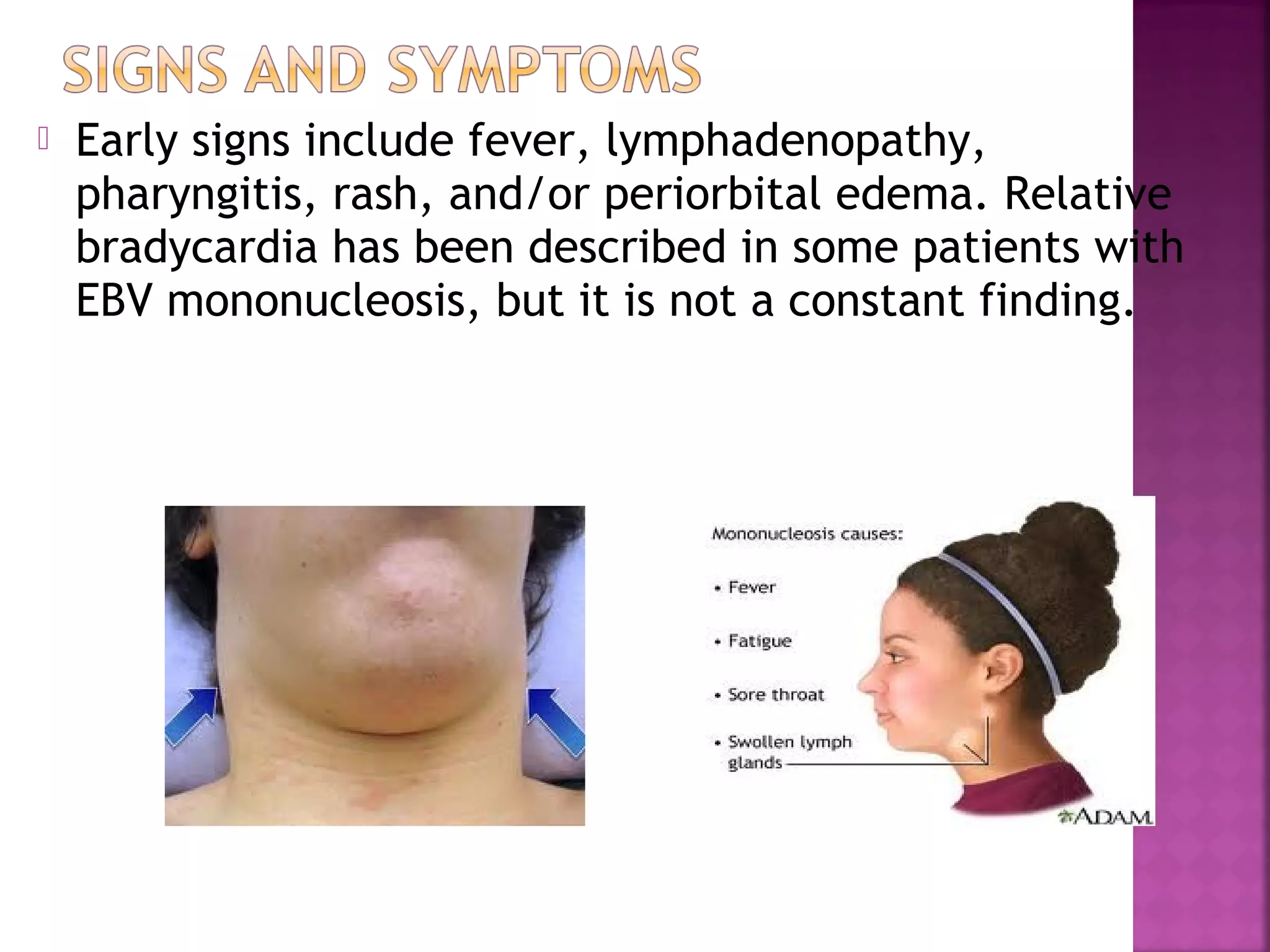  Early signs include fever, lymphadenopathy,
pharyngitis, rash, and/or periorbital edema. Relative
bradycardia has been described in some patients with
EBV mononucleosis, but it is not a constant finding.