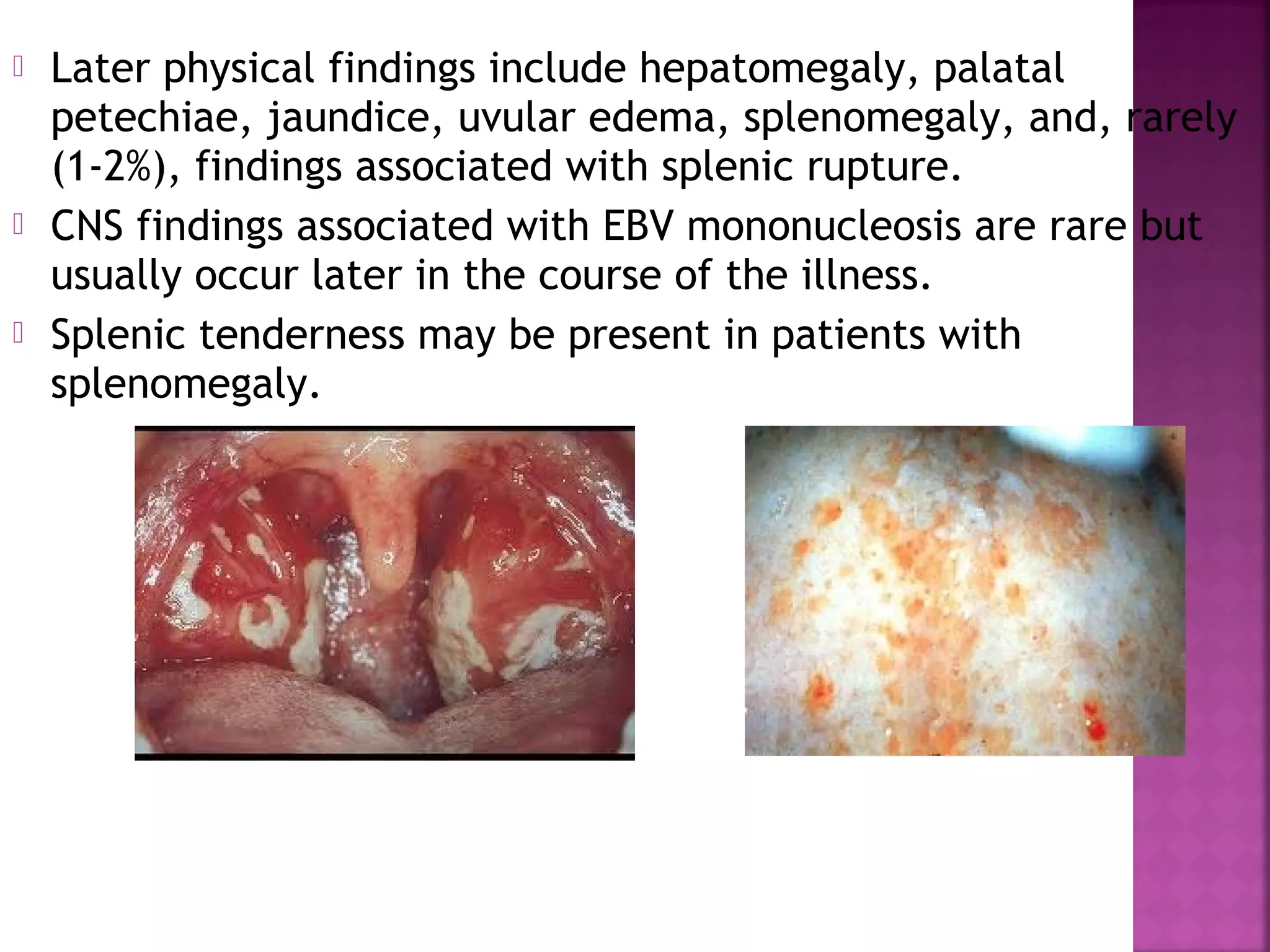  Later physical findings include hepatomegaly, palatal
petechiae, jaundice, uvular edema, splenomegaly, and, rarely
(1-2%), findings associated with splenic rupture.
CNS findings associated with EBV mononucleosis are rare but
usually occur later in the course of the illness.
Splenic tenderness may be present in patients with
splenomegaly.