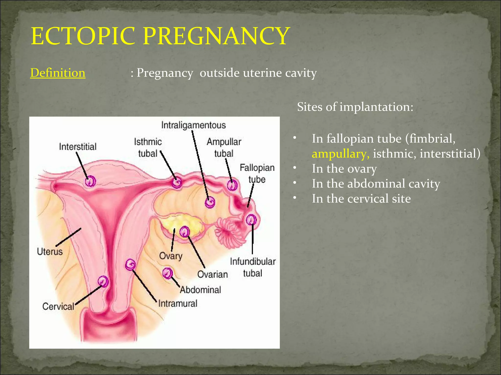 ECTOPIC PREGNANCY Definition : Pregnancy  outside uterine cavity In fallopian tube (fimbrial,  ampullary,  isthmic, interstitial) In the ovary In the abdominal cavity In the cervical site Sites of implantation: 