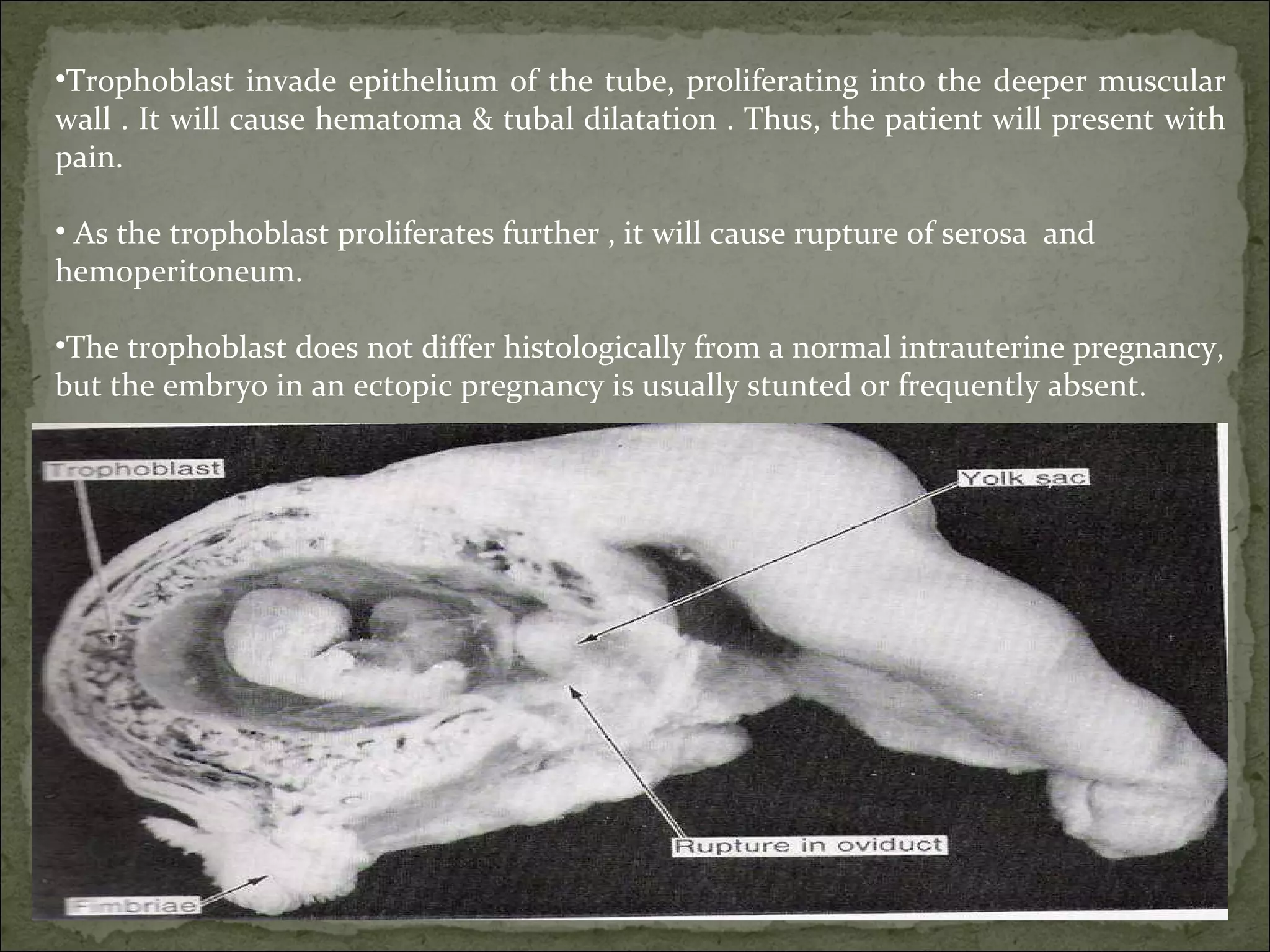Trophoblast invade epithelium of the tube, proliferating into the deeper muscular wall . It will cause hematoma & tubal dilatation . Thus, the patient will present with pain. As the trophoblast proliferates further , it will cause rupture of serosa  and hemoperitoneum. The trophoblast does not differ histologically from a normal intrauterine pregnancy, but the embryo in an ectopic pregnancy is usually stunted or frequently absent.  
