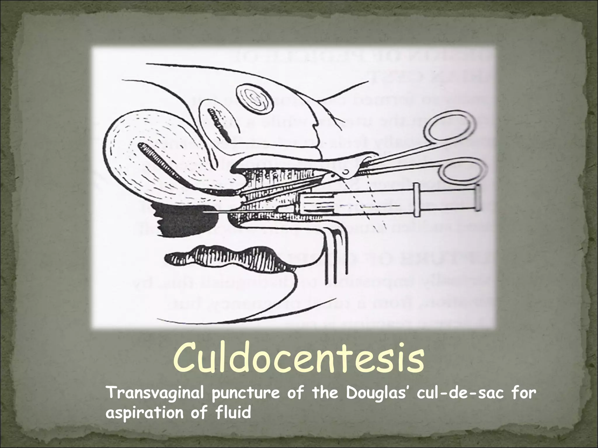 Culdocentesis Transvaginal puncture of the Douglas’ cul-de-sac for aspiration of fluid 