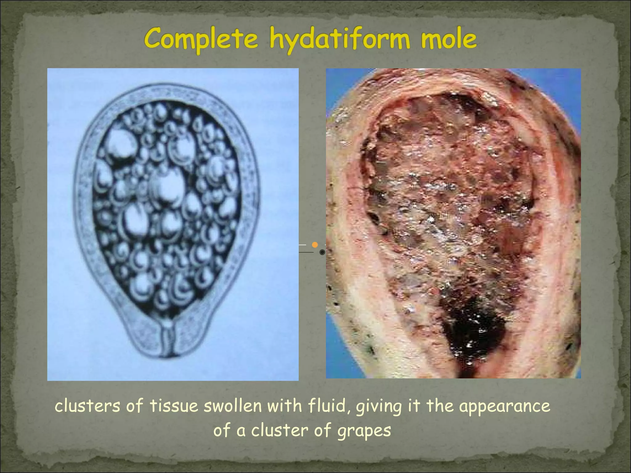 clusters of tissue swollen with fluid, giving it the appearance of a cluster of grapes 