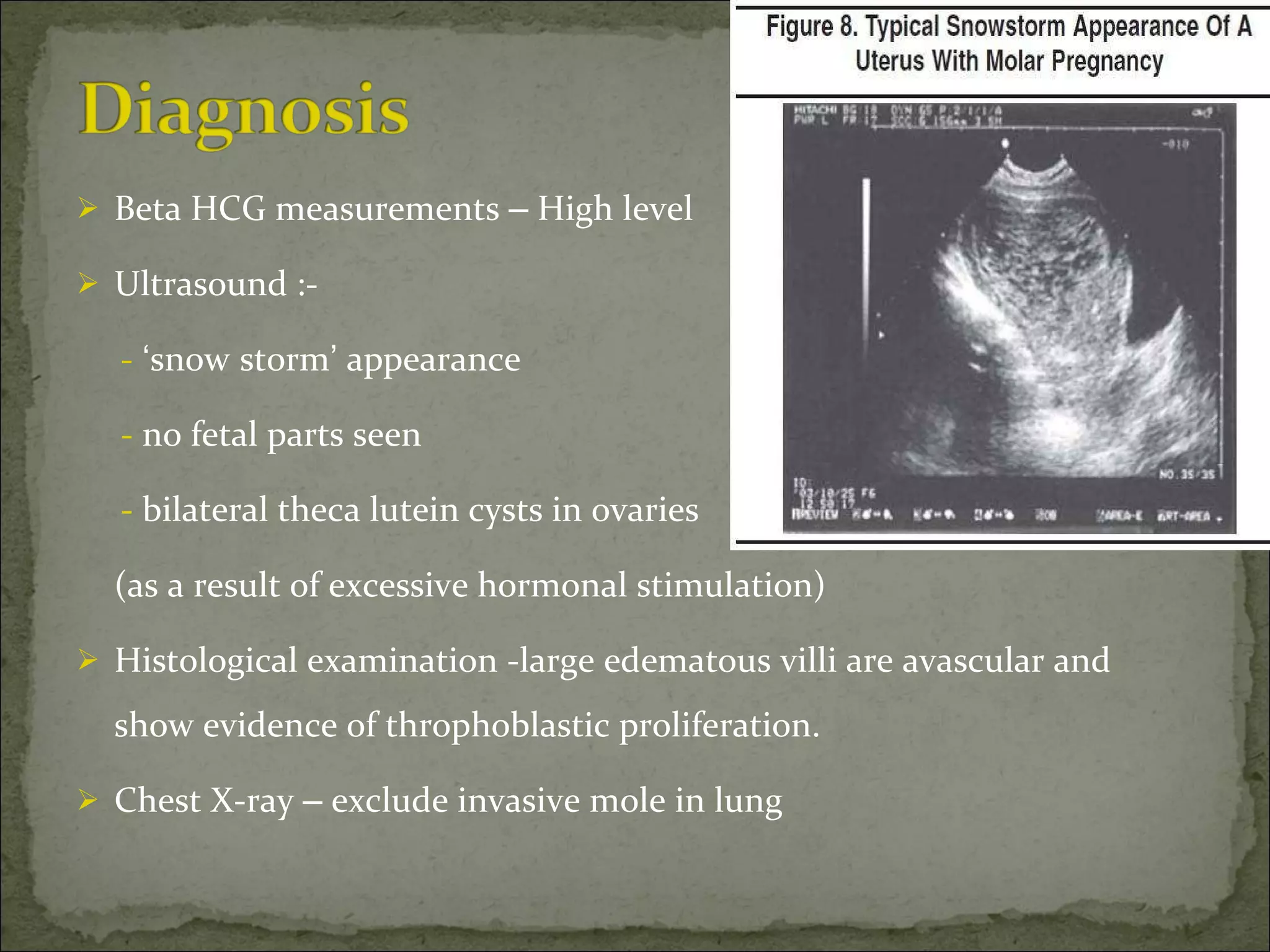 Beta HCG measurements  –  High level Ultrasound :- -   ‘ snow   storm ’  appearance -  no fetal parts seen -  bilateral theca lutein cysts in ovaries (as a result of excessive hormonal stimulation) Histological examination -large edematous villi are avascular and show evidence of throphoblastic proliferation. Chest X-ray  –  exclude invasive mole in lung 