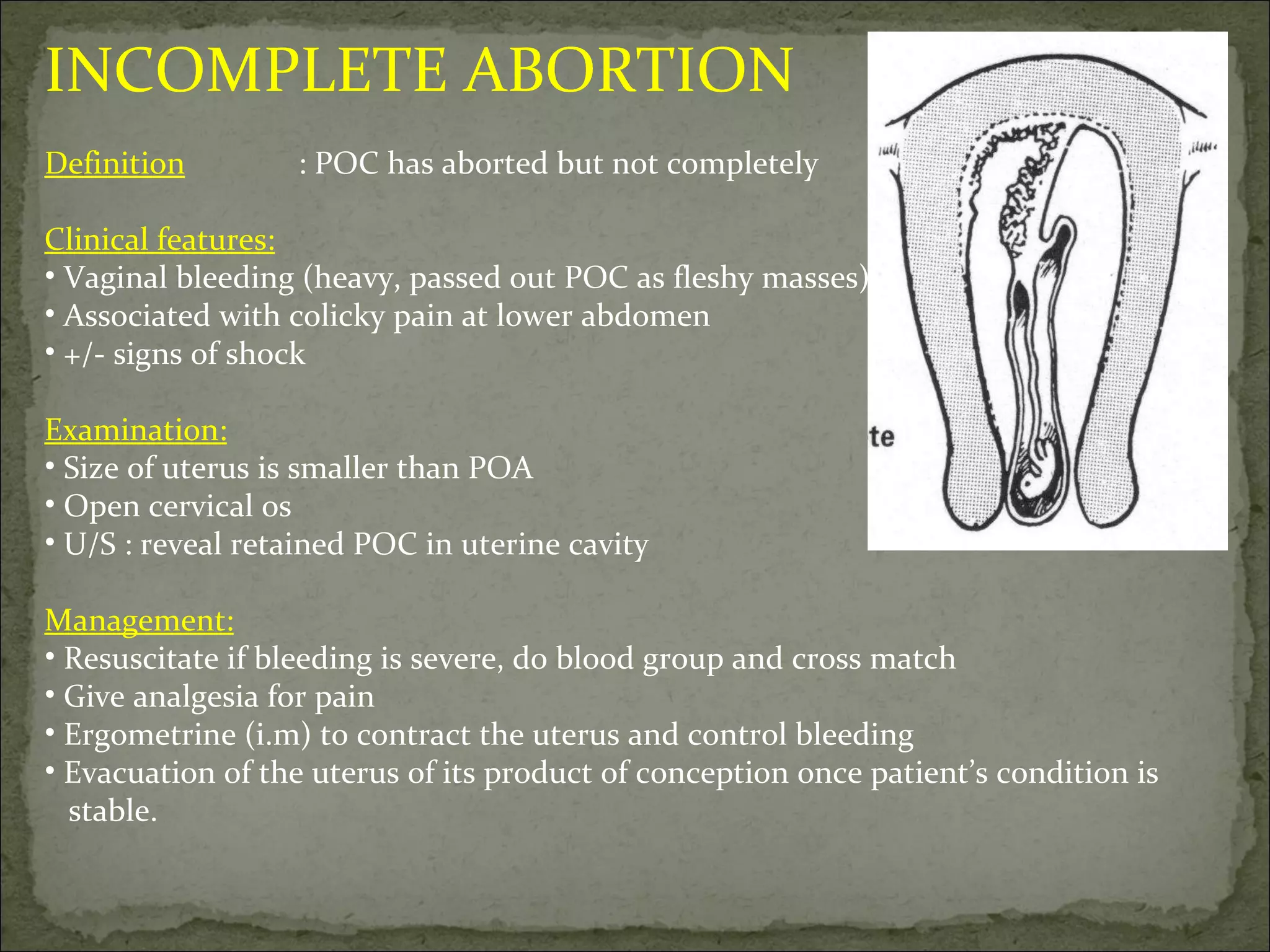 INCOMPLETE ABORTION Definition : POC has aborted but not completely Clinical features: Vaginal bleeding (heavy, passed out POC as fleshy masses) Associated with colicky pain at lower abdomen +/- signs of shock Examination: Size of uterus is smaller than POA Open cervical os U/S : reveal retained POC in uterine cavity Management: Resuscitate if bleeding is severe, do blood group and cross match Give analgesia for pain Ergometrine (i.m) to contract the uterus and control bleeding Evacuation of the uterus of its product of conception once patient’s condition is  stable. 
