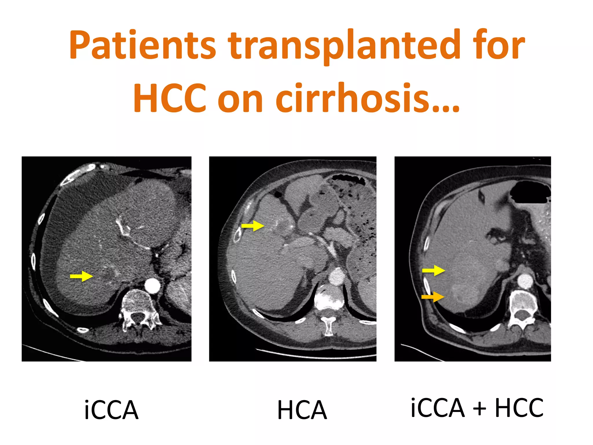 Liver transplantation vs Resection in cholangiocarcinoma on cirrhosis | PPT
