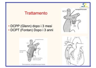Trattamento
• DCPP (Glenn) dopo i 3 mesi
• DCPT (Fontan) Dopo i 3 anni
 