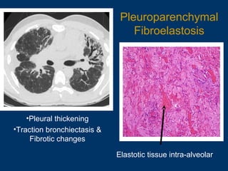 Pleuroparenchymal
Fibroelastosis
•Pleural thickening
•Traction bronchiectasis &
Fibrotic changes
Elastotic tissue intra-alveolar
 
