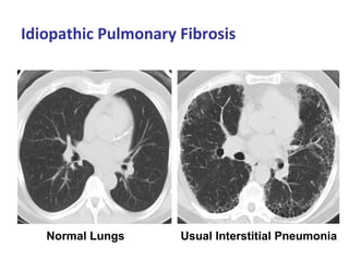 Idiopathic Pulmonary Fibrosis
Normal Lungs Usual Interstitial Pneumonia
 