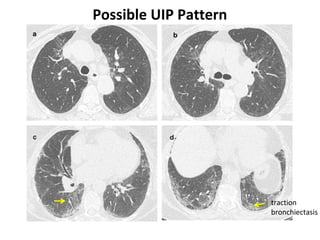 Possible UIP Pattern
traction
bronchiectasis
 