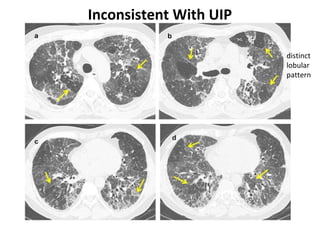 Inconsistent With UIP
distinct
lobular
pattern
 