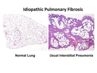 Idiopathic Pulmonary Fibrosis
Normal Lung Usual Interstitial Pneumonia
 