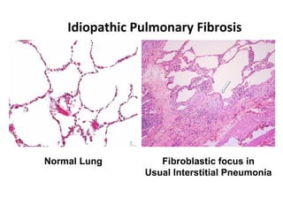 Idiopathic Pulmonary Fibrosis
Normal Lung Fibroblastic focus in
Usual Interstitial Pneumonia
 