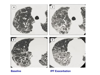 Baseline IPF Exacerbation
 