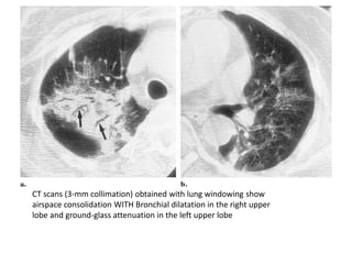 Connective tissue disease associated ILD | PPTX