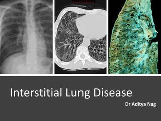 Interstitial Lung Disease
Dr Aditya Nag
 