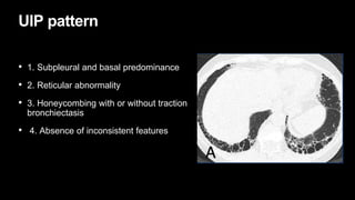UIP pattern
• 1. Subpleural and basal predominance
• 2. Reticular abnormality
• 3. Honeycombing with or without traction
bronchiectasis
• 4. Absence of inconsistent features
 