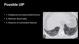 Possible UIP
• 1. Subpleural and basal predominance
• 2. Reticular abnormality
• 3. Absence of inconsistent features
 
