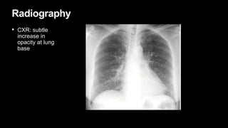 Radiography
• CXR: subtle
increase in
opacity at lung
base
 