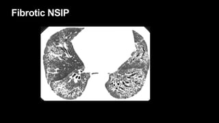 Fibrotic NSIP
 