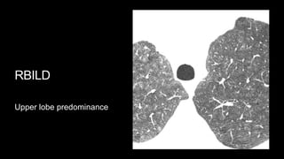 RBILD
Upper lobe predominance
 