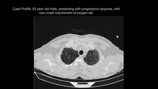 Case Profile: 63 year old male, presenting with progressive dyspnea, with
new onset requirement of oxygen aid.
 