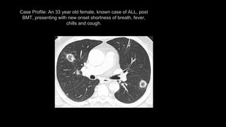 Case Profile: An 33 year old female, known case of ALL, post
BMT, presenting with new onset shortness of breath, fever,
chills and cough.
 