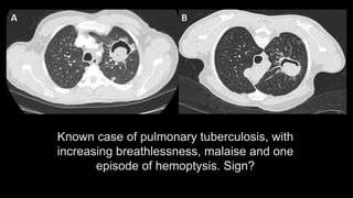 Known case of pulmonary tuberculosis, with
increasing breathlessness, malaise and one
episode of hemoptysis. Sign?
 