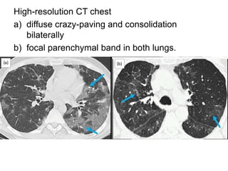 Clopidogrel induced interstitial lung disease | PPTX