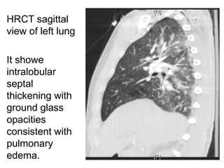 Clopidogrel induced interstitial lung disease | PPTX