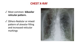 Basilar Reticular Pattern Interstitial lung disorders by Pharan patil | PPTX