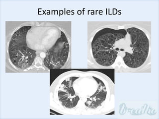 Examples of rare ILDs
 