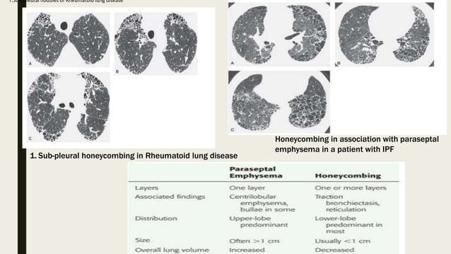 Interstitial lung disease and Occupational lung disease HRCT | PPTX ...