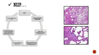 Nsip Classification Interstitial lung disease old classification and management and ...