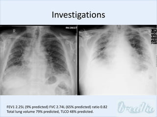 Investigations
FEV1 2.25L (9% predicted) FVC 2.74L (65% predicted) ratio 0.82
Total lung volume 79% predicted, TLCO 48% predicted.
CXR
CT
 