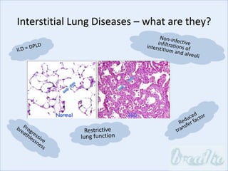 Interstitial Lung Diseases – what are they?
 