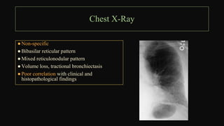 Basilar Reticular Pattern INTERSTITIAL LUNG DISEASE Pattern Approach main.pptx