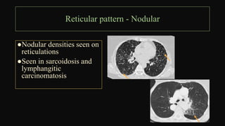 What Is A Reticular Pattern INTERSTITIAL LUNG DISEASE Pattern Approach main.pptx