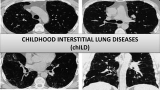 CHILDHOOD INTERSTITIAL LUNG DISEASES
(chILD)
 